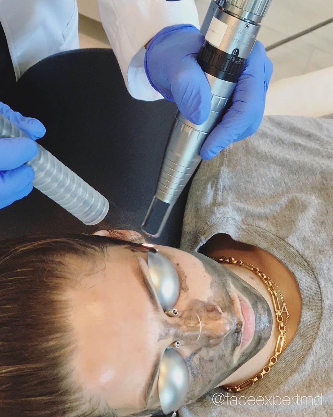 01 september 2020: The #HollywoodLaserPeel - our newest solution to instantly glowing skin! No downtime, evens out skin tone, and eliminates fine lines. These are only a few of the benefits of our favorite new treatment. Safe on sensitive skin! @ashleygreene
.
Use the links in our bio to book yours. #followus
 .
🌍https://amfacialplastics.com
📞Call: 310.659.9900 to schedule a consultation.
📬Email: info@amfacialplastics.com
.
#amfacialplastics #faceexpertmd #nonablativelaser #lutronic #spectralaser #carbonpeel #AshleyGreene
