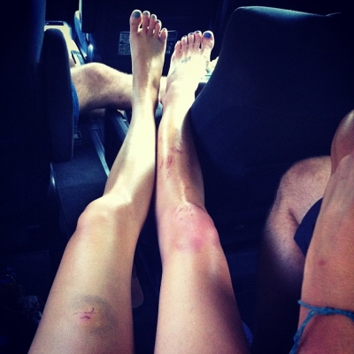21 Juni 2013: Monkey bite, broken toe, and coral reef gashes. #cantstopwontstop :) @ashleygreene
